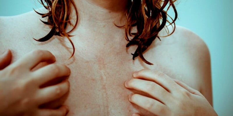 Femme avec des problèmes de peau - Mycose du sein