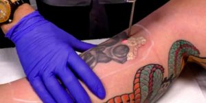 Séance de détatouage au laser